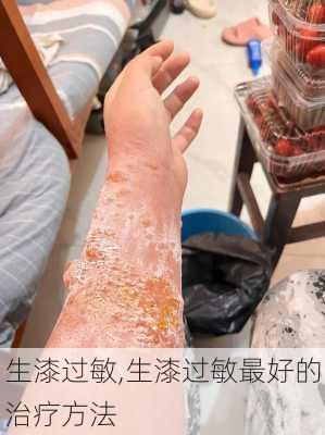 生漆过敏,生漆过敏最好的治疗方法